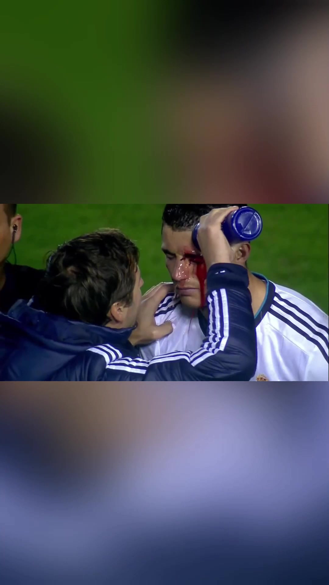 硬漢C羅眉骨破裂現(xiàn)場縫針單眼進球霸氣回擊對手